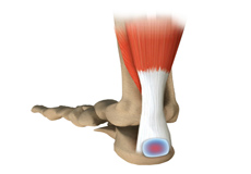 Achilles Tendon Bursitis