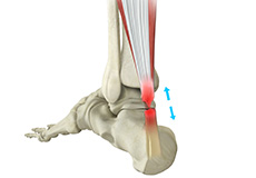 Achilles Tendon Repair