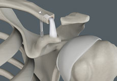 Acromioclavicular (AC) Joint Reconstruction
