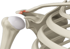 Acromioclavicular (AC) Arthritis