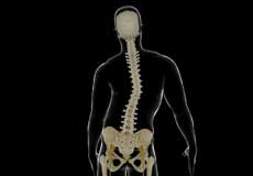 Adolescent Idiopathic Scoliosis