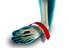 Ankle Instability Surgery