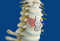 Anterior Cervical Corpectomy and Fusion