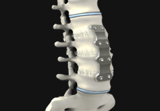 Anterior Lumbar Corpectomy and Fusion