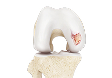 arthritis-of-the-knee Image