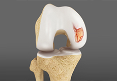 articular-cartilage-repair