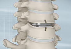 Artificial Cervical Disc Replacement