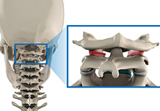 Spinal Instability