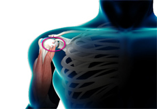 Bicep Tendon Rupture at Shoulder