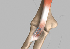 biceps-tendon-repair