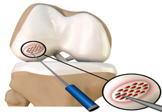 Cartilage Microfracture