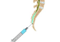 Caudal Epidural Injection