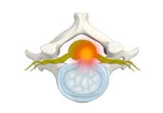 Cervical Disc Protrusion