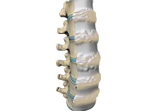 Diffuse Idiopathic Skeletal Hyperostosis (DISH)