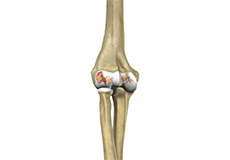 elbow-arthritis