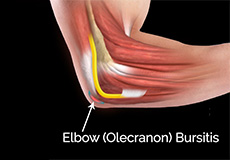 elbow-or-olecranon-bursitis