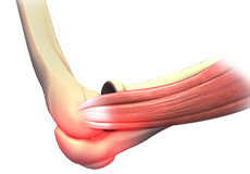 elbow-sprain