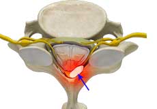 Epidural Abscess