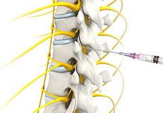 Spine Injections