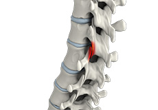 Lumbar Facet Joint Arthropathy