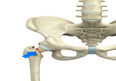 Femoral Neck Fracture