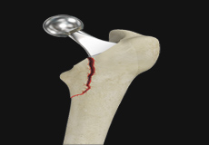 Femur Fracture