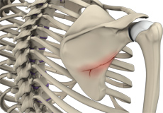 Fracture of the Shoulder Blade (Scapula)