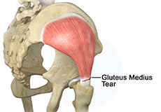 gluteus-medius-tear