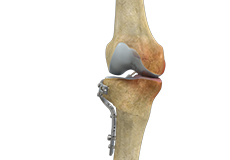 high-tibial-osteotomy