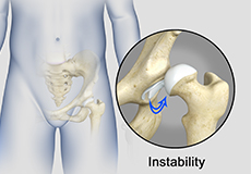 hip-instability