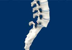 Isthmic Spondylolisthesis