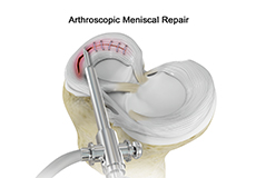 knee-arthroscopic-meniscal-repair