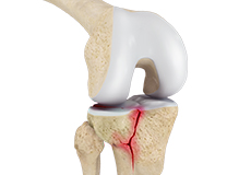 knee-fracture