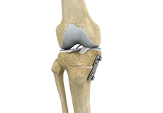 knee-osteotomy