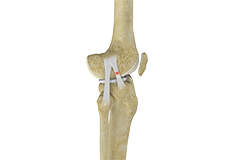 knee-sprain