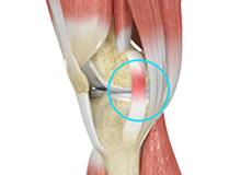 mcl-sprain