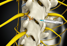 Medial Branch Block Injections
