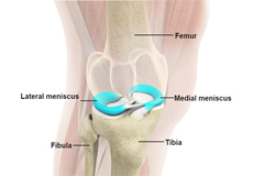 Medial Meniscus Syndrome