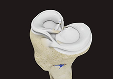 meniscus-repair