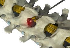 Microdiscectomy