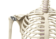 Minimally Invasive Shoulder Joint Replacement