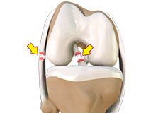 multi-ligament-injury Image