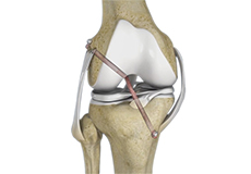 multi-ligament-knee-reconstruction
