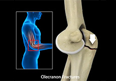 olecranon-fractures-text