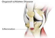 Osgood-Schlatter Disease