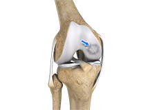 osteochondritis-dissecans-knee