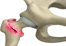 Osteoporotic Fractures