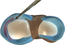 Partial Arthroscopic Meniscectomy