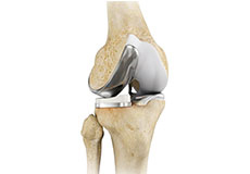 partial-knee-resurfacing