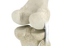 posterolateral-corner-reconstruction